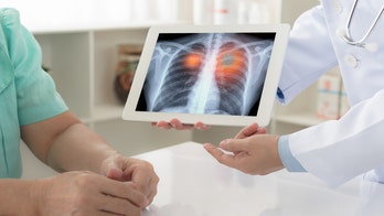 AI model could help predict lung cancer risks in non-smokers, study finds: ‘Significant advancement’